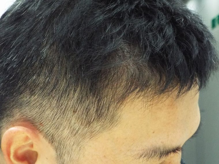 ↑薄毛が気になるこめかみ上の部分