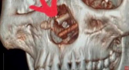 頭痛に悩むベトナム人男性、精密検査で頭蓋骨にとんでもない物が見つかる