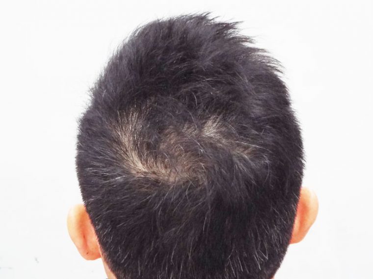 頭皮に効くドライヤー は1か月で中年男の薄毛を止められたか シャープ スカルプエステ 使用前と使用後を比べた結果 Getnavi Web ゲットナビ
