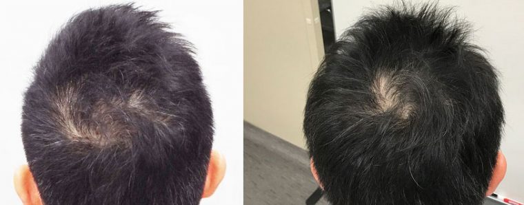 家電 頭皮に効くドライヤー は1か月で中年男の薄毛を止められたか シャープ スカルプエステ 使用前と使用後を比べた結果 Getnavi Web 毎日新聞