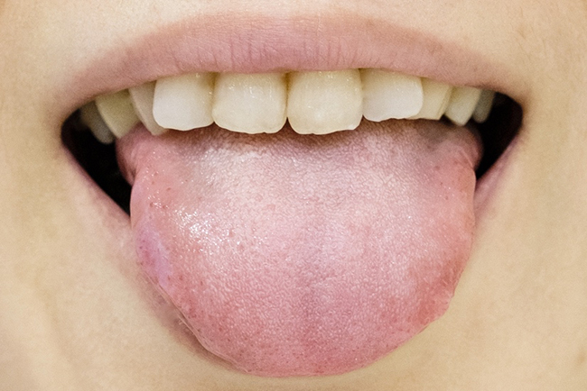 舌 が 白い 漢方
